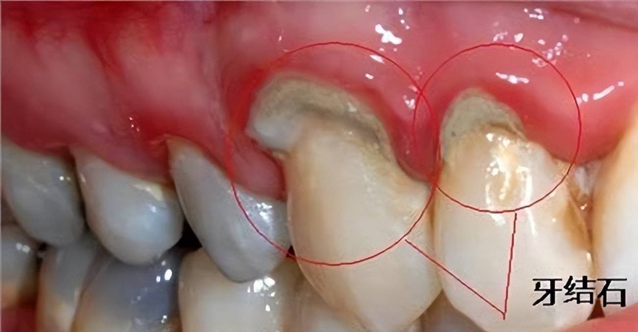 牙结石症状图片
