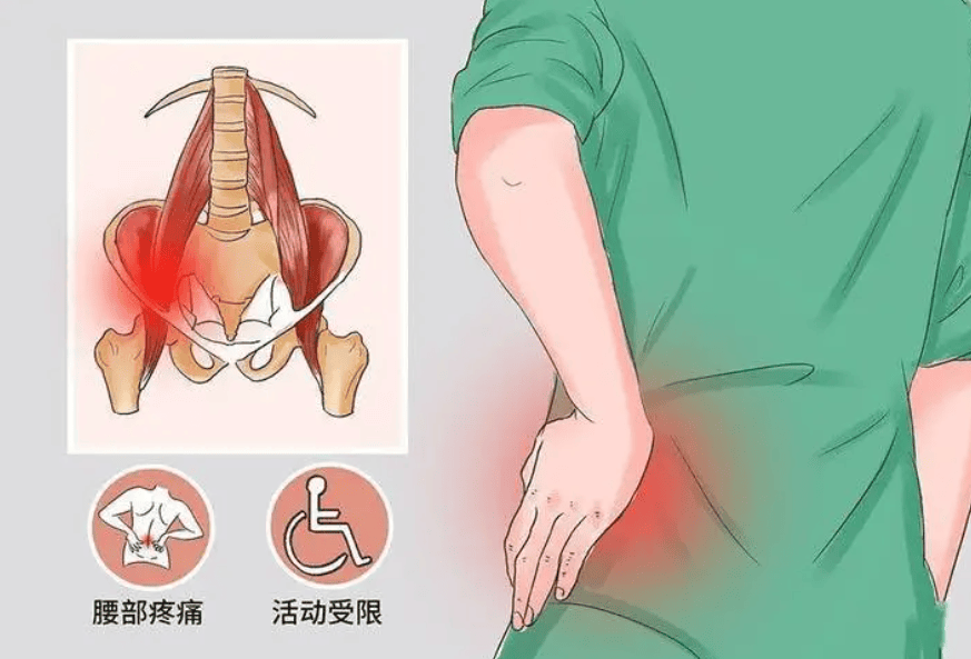 腰肌劳损疼痛位置图图片