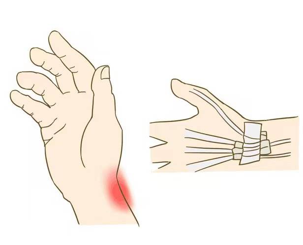 手指腱鞘炎有什么症状?这个原因不要忘记