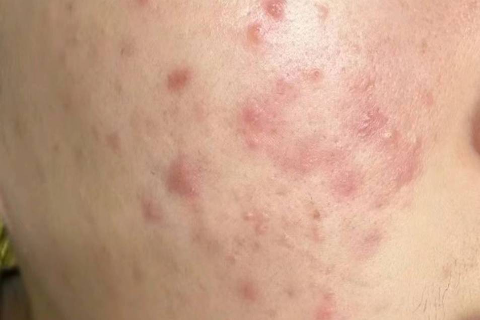 过来人教你在家轻松去除红黑痘印!方法简单一学就会!短时间见效_效果_祛痘_维生素