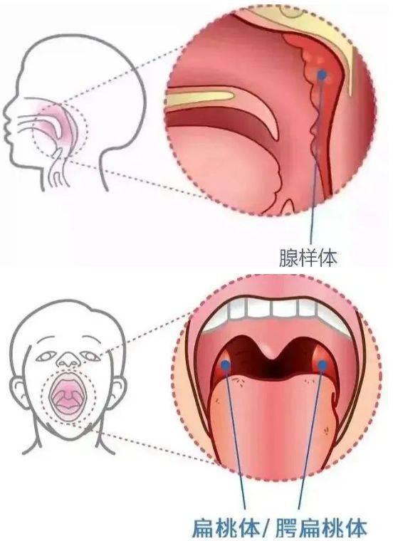 药王烙 扁桃体