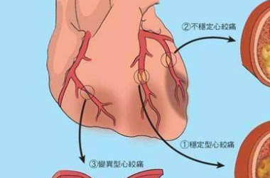 很多人认为胸痛就是心绞痛,no!什么是心绞痛呢?