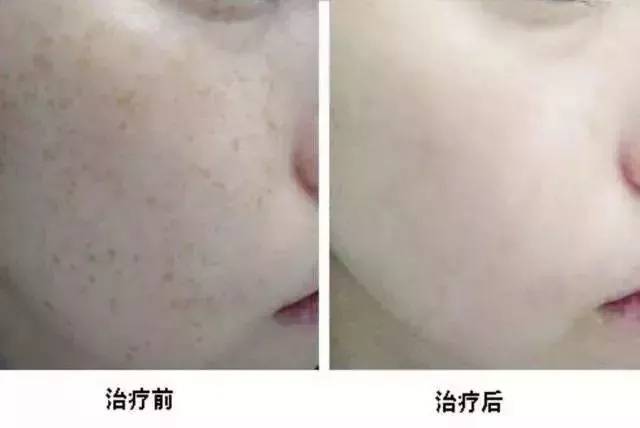 超皮秒超皮秒在照射皮肤后会产生一种高能-量击碎黑色素颗粒,这些黑