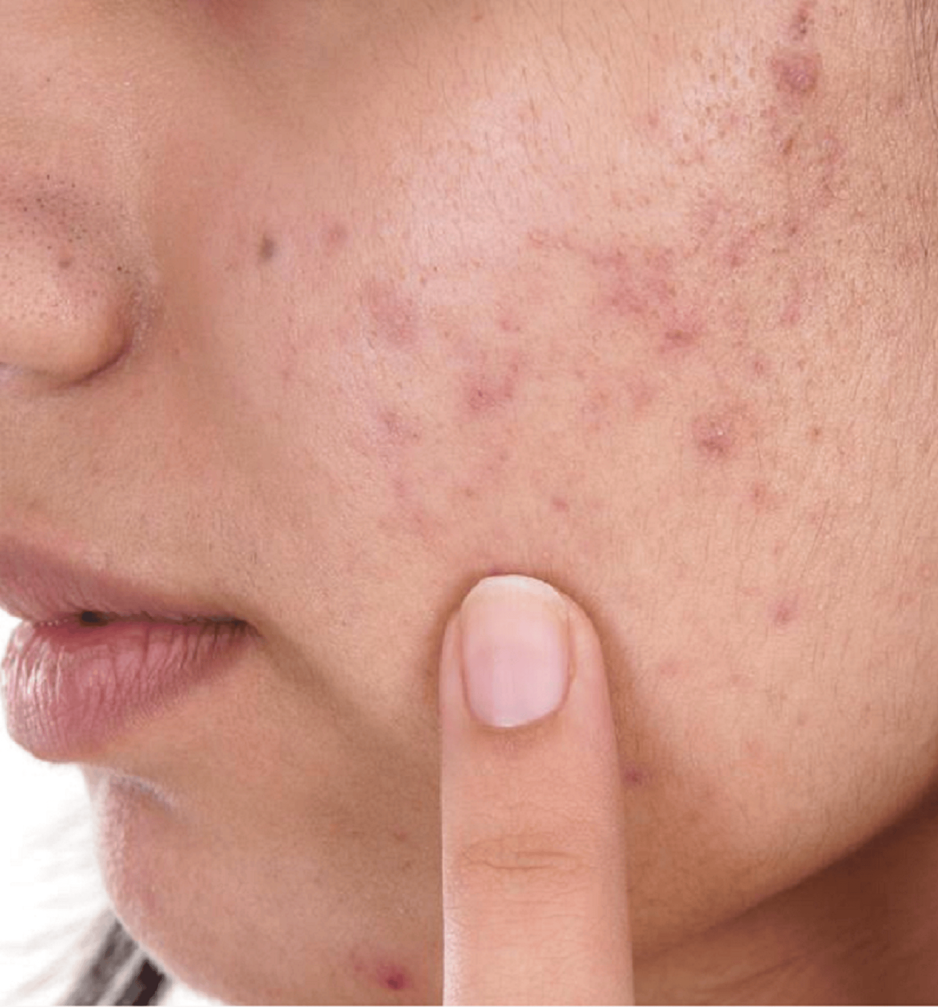 【外用维生素】我们可以借助维生素c和维生素e涂抹来辅助去除疤痕