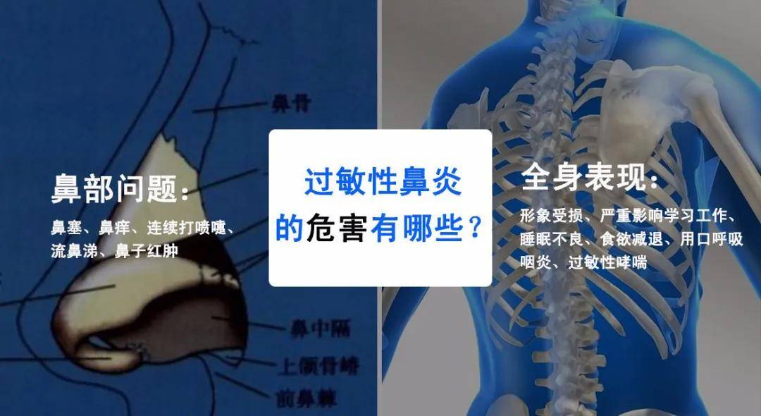 逸青糠酸莫米松鼻喷雾剂科普:过敏性鼻炎拖下去不治会有什么后果?