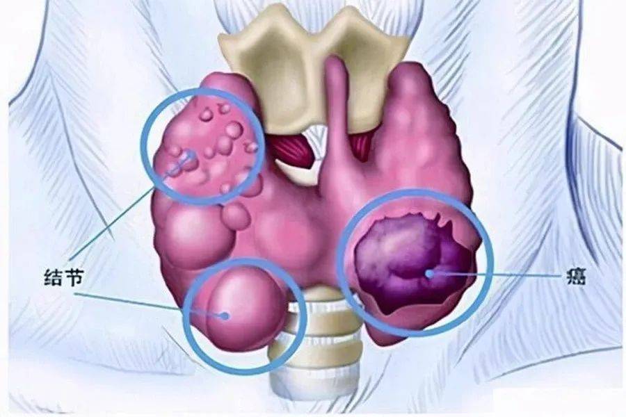 甲状腺瘤4公分图片图片