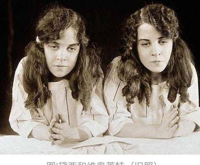 连体姐妹:二人各有老公,姐姐死后,妹妹和尸体共存2天去世