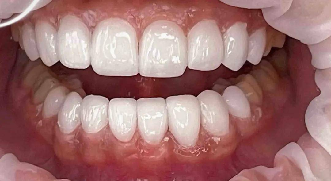 牙齿色泽暗淡,四环素牙,氟斑牙,或是岁月的痕迹使牙齿泛黄,形态上的