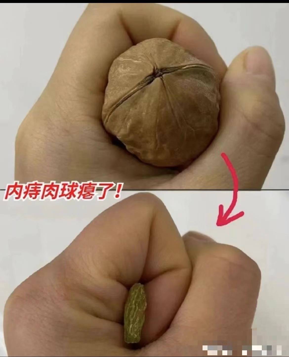 痔疮肉球如何有效治疗?亲身经历证明,药物治疗要远胜于手术!