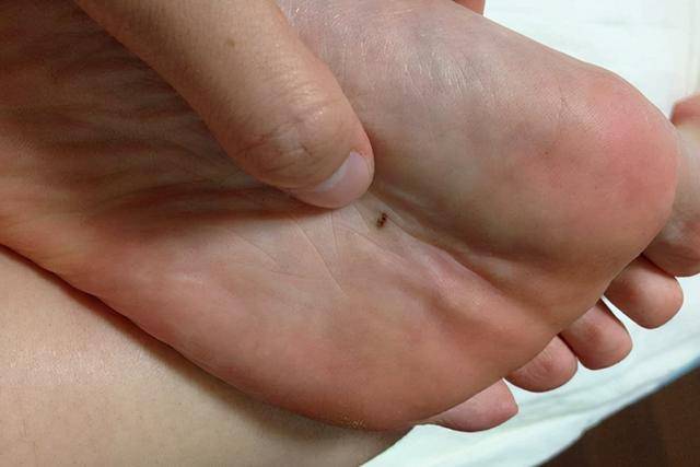 "古人说痣"顺口溜:原来长痣也有说法,8大"富贵痣"可信吗