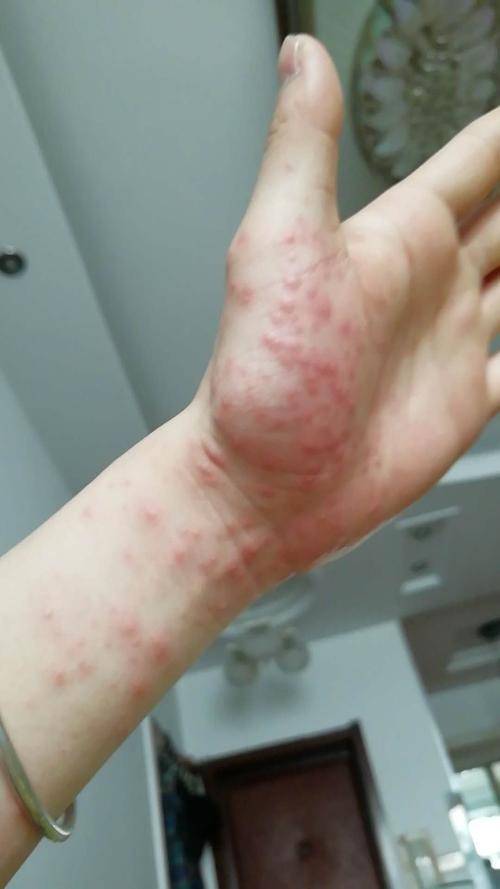 女生闻到小龙虾气味过敏全身发红,称医生都没办法,电话摇人