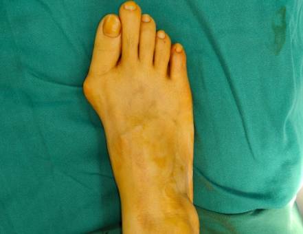 拇外翻最佳手术年龄:选择合适时机,告别足部疼痛!