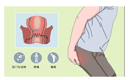 贵阳东大肛肠医院:肛门总是湿湿的,还有分泌物!正常吗?