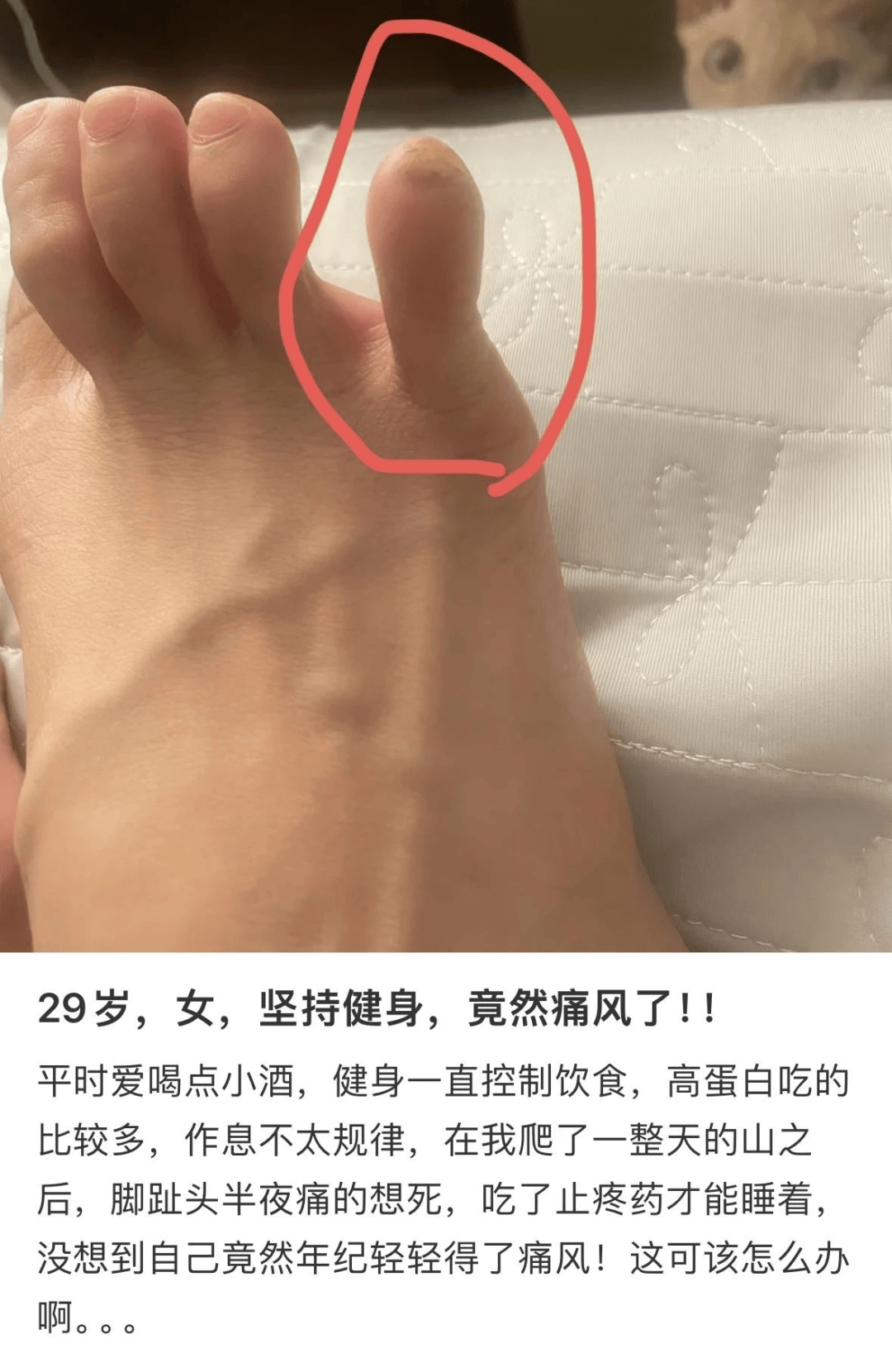 尿酸_治疗_关节