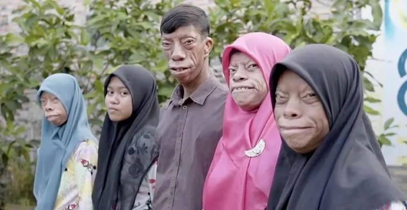 印尼4兄妹患罕见怪病,长着一张"动物"的脸,酷似三星堆面具