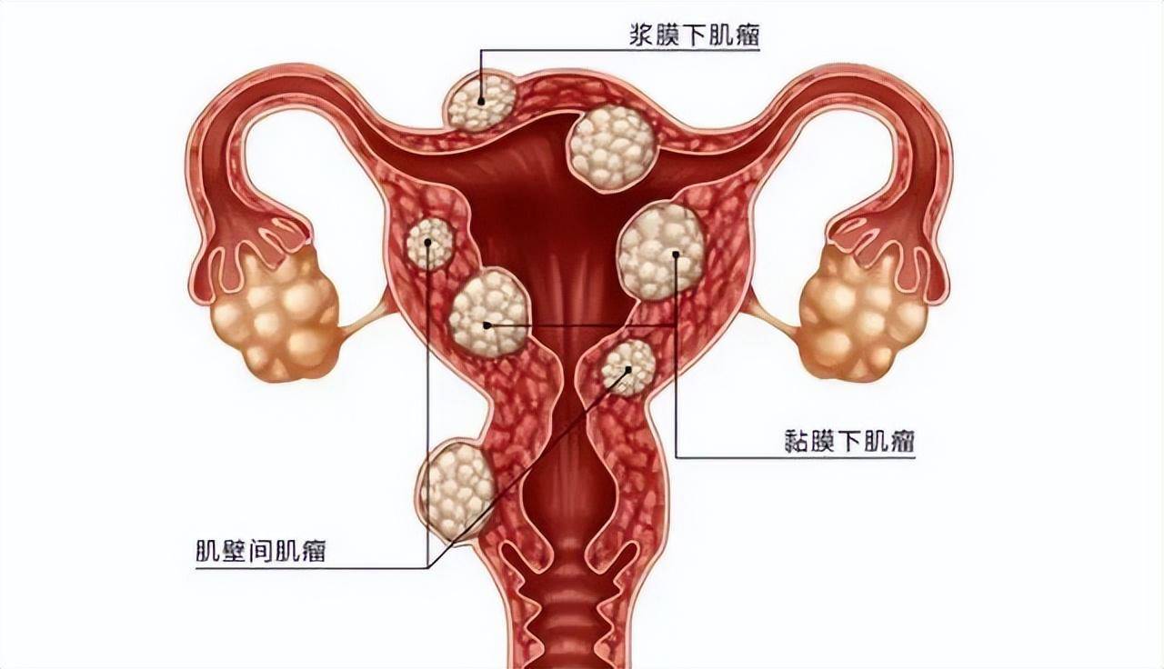 子宫前壁肌瘤的位置图图片