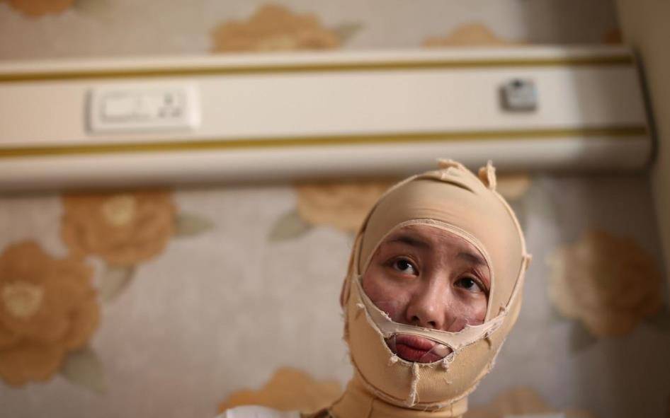 10年前合肥女孩拒绝同学求爱,竟遭对方一把火毁容,如今怎么样了