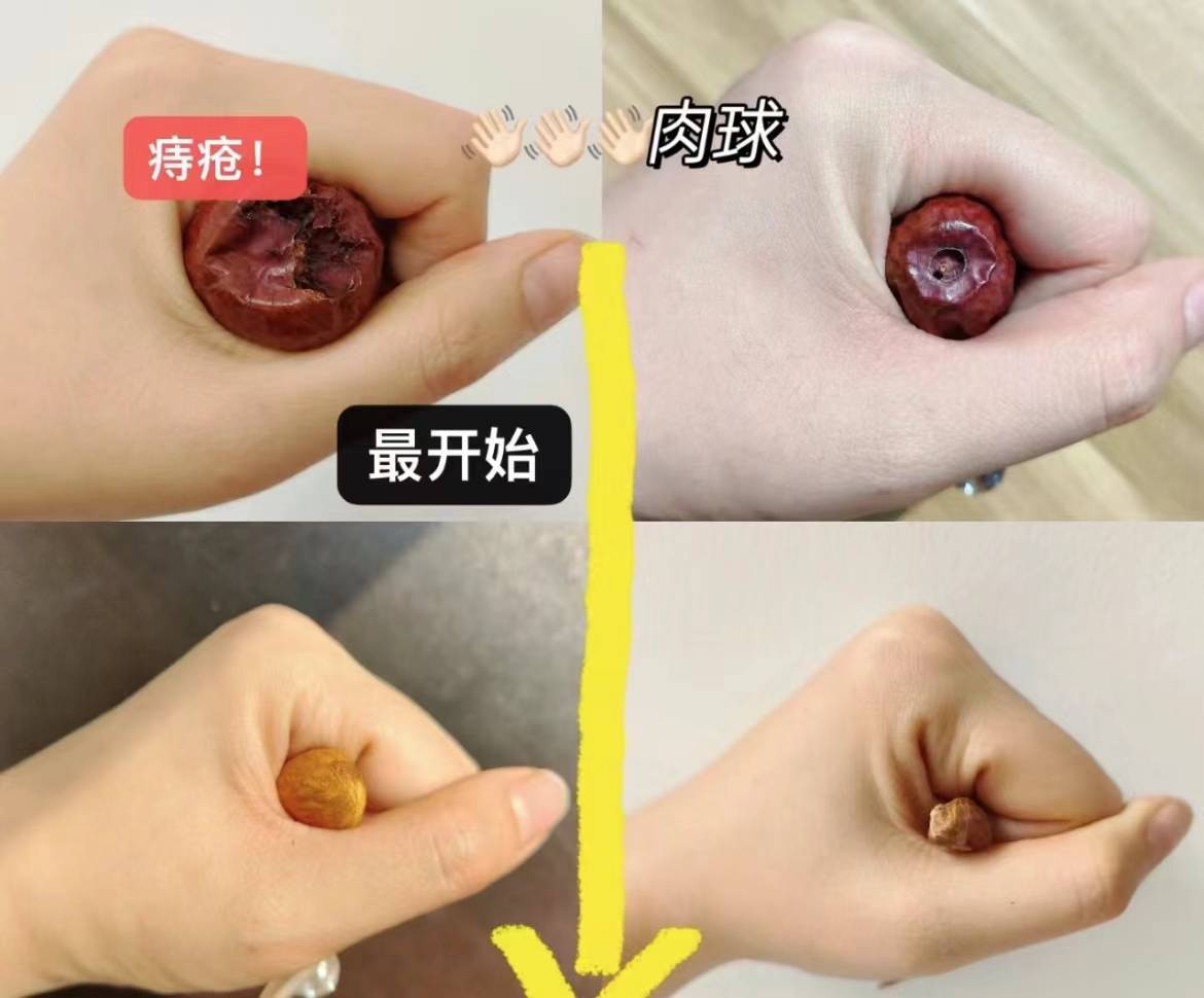 加速康复:每天进行提肛运动,以促进肛门区域的血液循环,帮助痔疮的