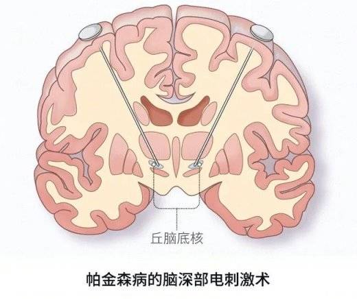 上海东方肝胆外科医院神经外科成功为帕金森病患者植入脑起搏器