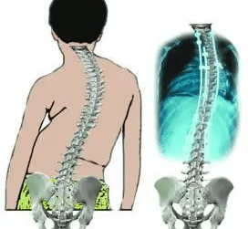儿童腰部脊柱凸起发黑图片