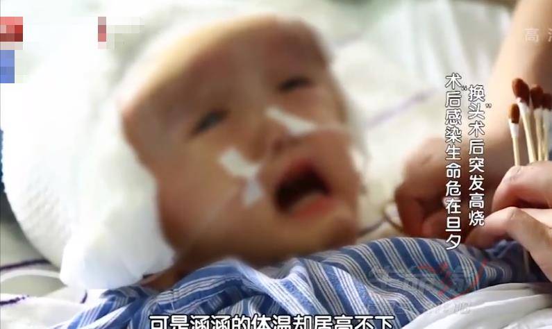 真实故事:湖南3岁半女童头颅重达20斤,医生冒险做"换头"手术