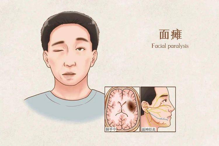 吹空调吹出面瘫说法存在误区:面瘫和吹空调没关系