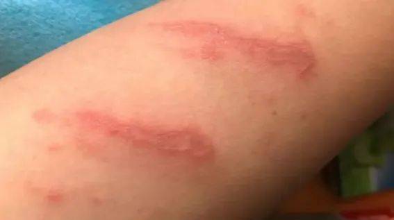 千万不要拍它!_毒液_虫子_昆虫