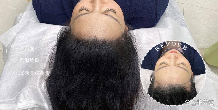 创新头皮管理,实现科技生发——绒毛发际线_毛囊_技术_问题