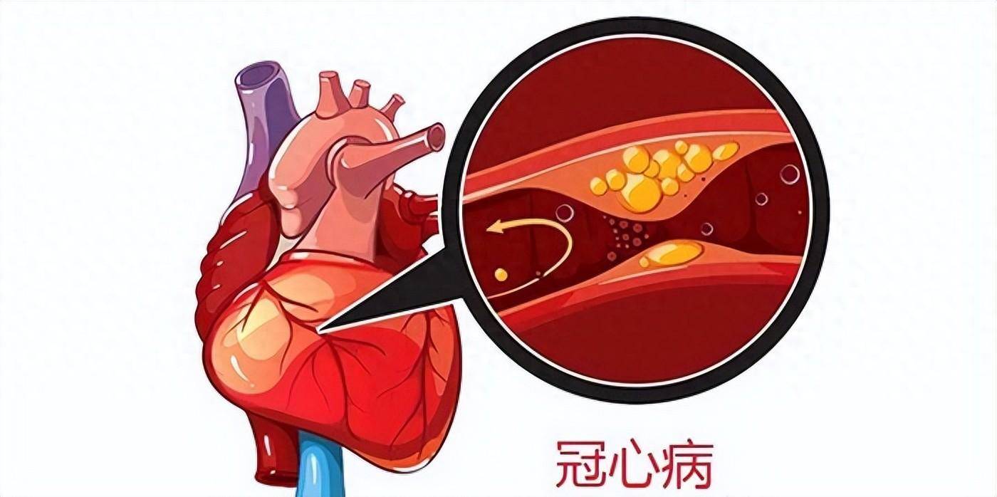 冠心病的漫画图片图片