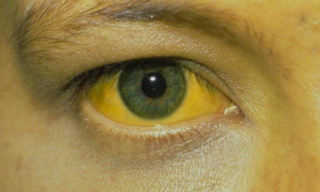 它们沉淀在面部的毛细血管或是皮肤粘膜上,便会造成脸色发黄的症状