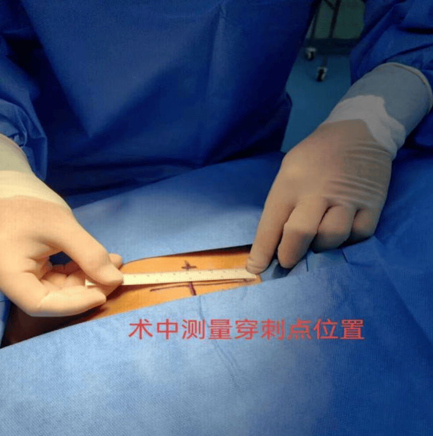 咸阳首例!西藏民族大学附属医院泌尿外科成功为患者安置"膀胱起搏器"
