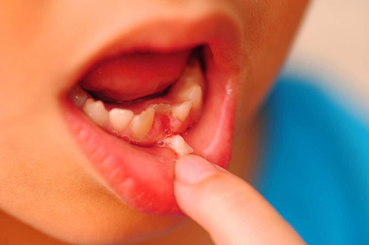 它可能发生在嘴里任何一个角落,不管是嘴唇,舌头,还是嘴巴的底部,牙龈