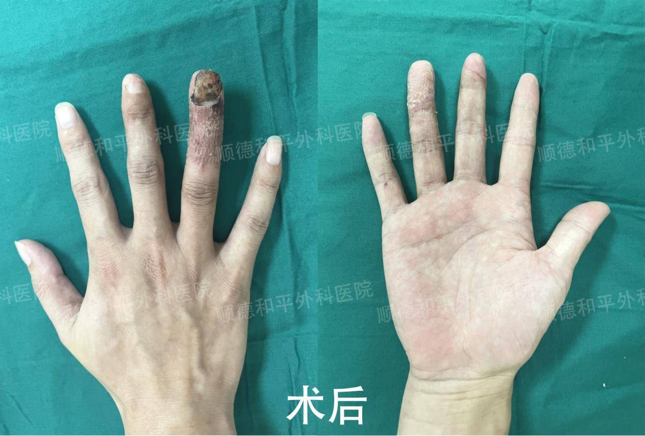 那家医院好_手指_患者_手部