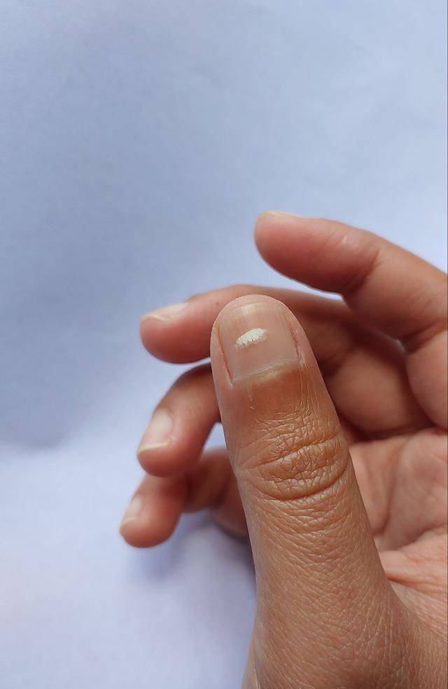 指甲出现这2个信号,不是"肝硬化"就是"肿瘤"?一次解释清楚