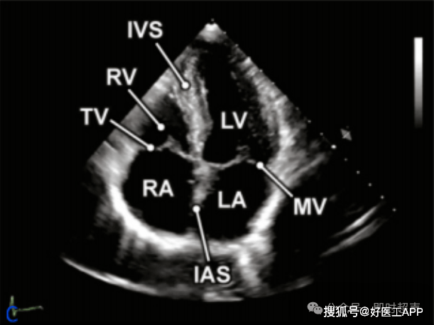 床旁超声心动图的基本测量