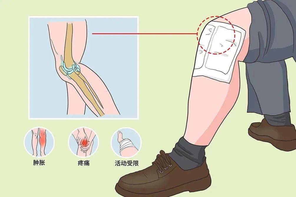 善式百科:膝关节里为什么会有"积液"?真相只有一个
