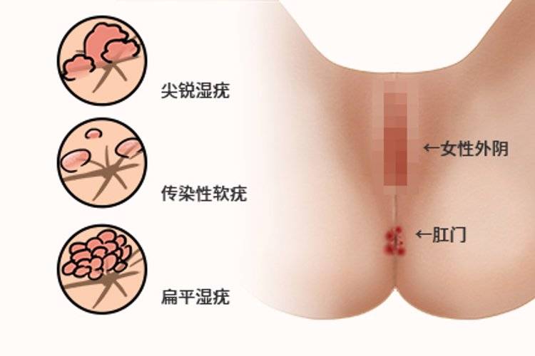 外阴癌的诱发因素、症状有哪些(如何预防外阴癌)