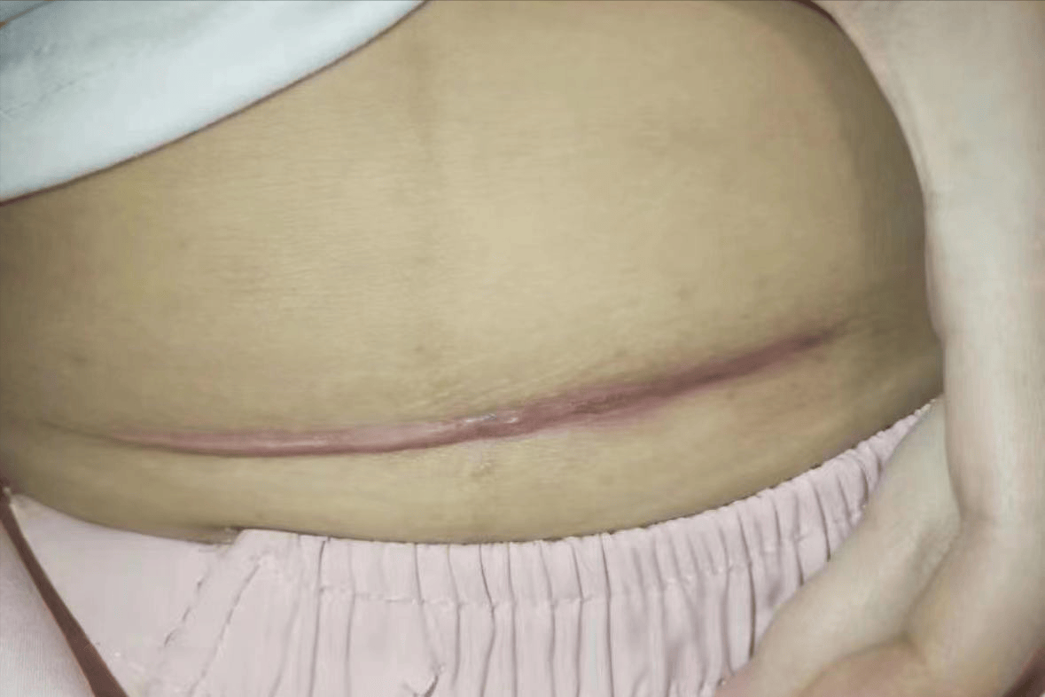 剖腹产术后疤痕增生凸起?又疼又痒?这3个低成本方法在家解决!