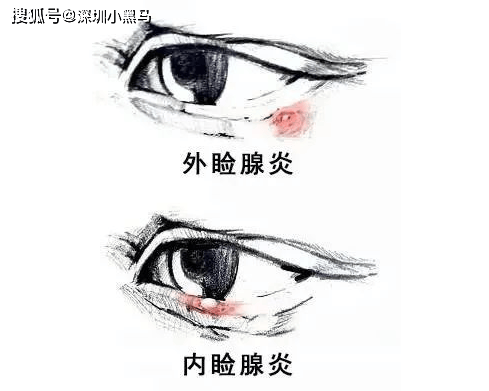 "针眼"是什么?