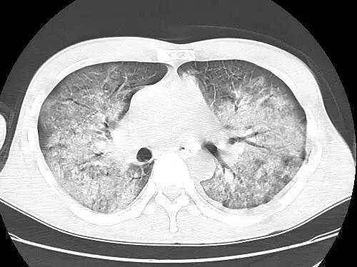 "白肺"患者越来越多,都要拍ct吗?医生:这3类人需尽早就医