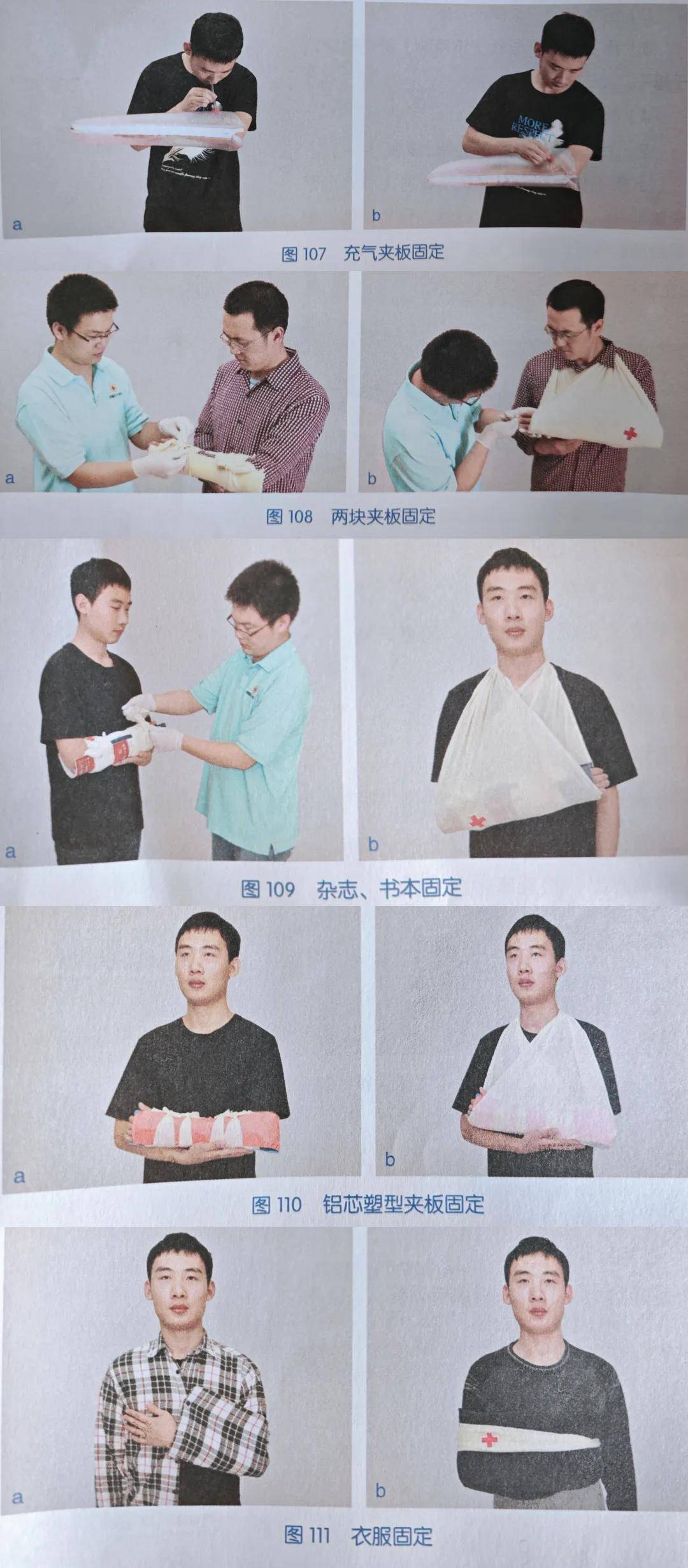 骨折固定有哪些方法