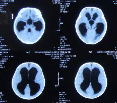 5月龄婴儿脑积水出现头颅增大,双眼落日征,发育迟缓