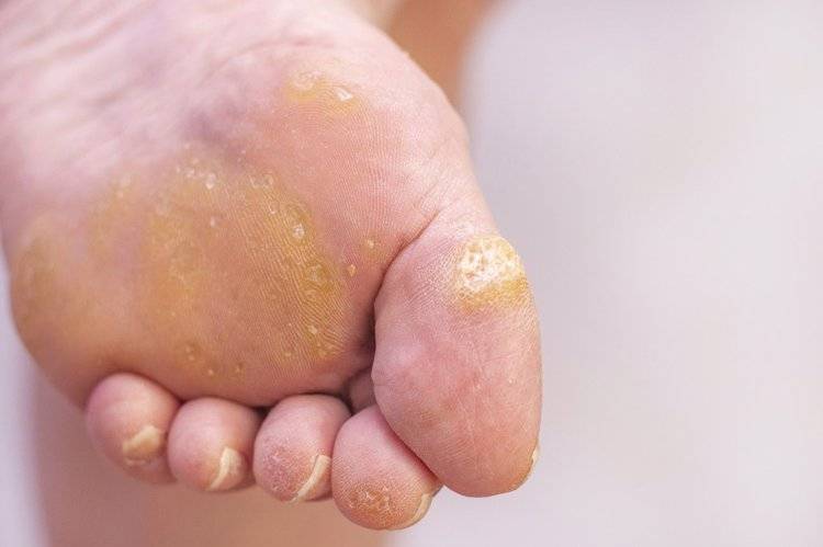 告诉你答案_部位_皮肤_瘊子