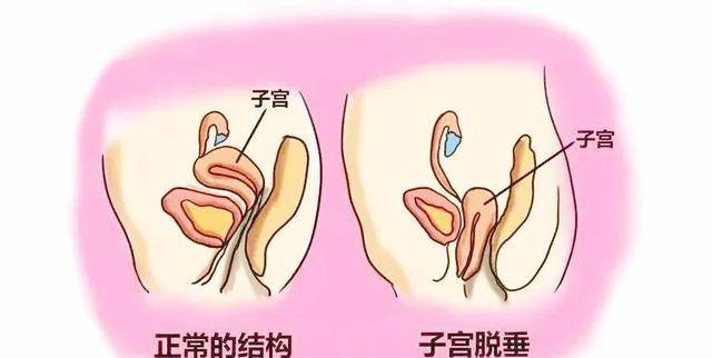 女人摘掉子宫后,和正常女性有什么不同?医生为你揭晓答案