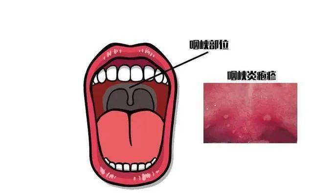 近期多地发现疱疹性咽峡炎感染病例,出现5个症状,及时就医