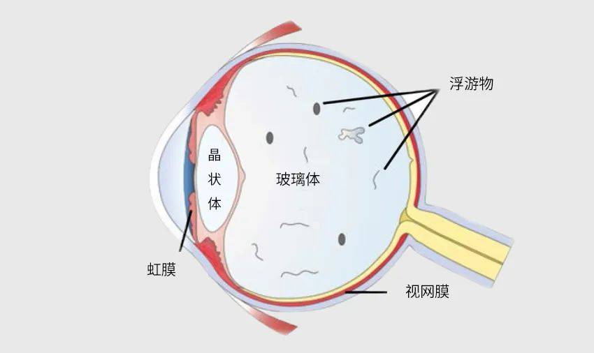 随着近视度数增加后,玻璃体腔也逐渐变大,加之随着年龄的增长,玻璃体