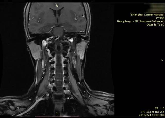 28岁女性鼻咽癌复发—质子治疗【携康就医指南】
