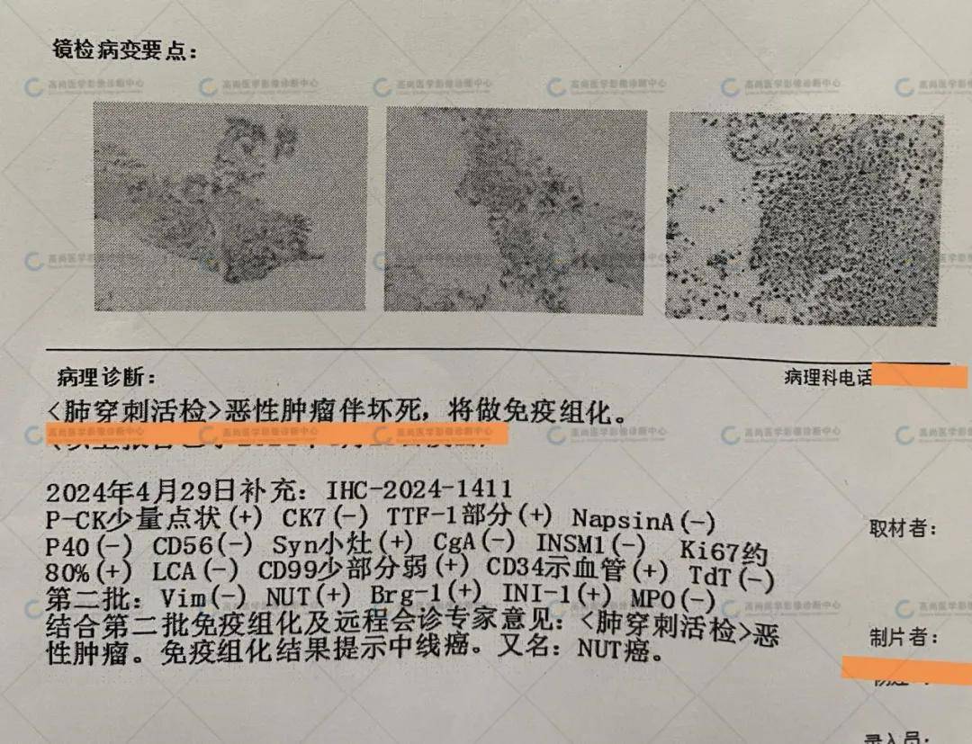 少见恶性肿瘤之肺部中线癌