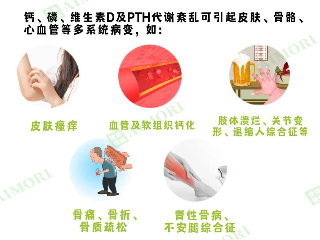 血钙降低等钙,磷代谢紊乱,进而刺激甲状旁腺激素(pth)持续分泌,甲状旁