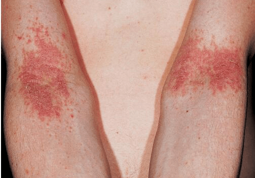 长沙治疗特应性皮炎医院!